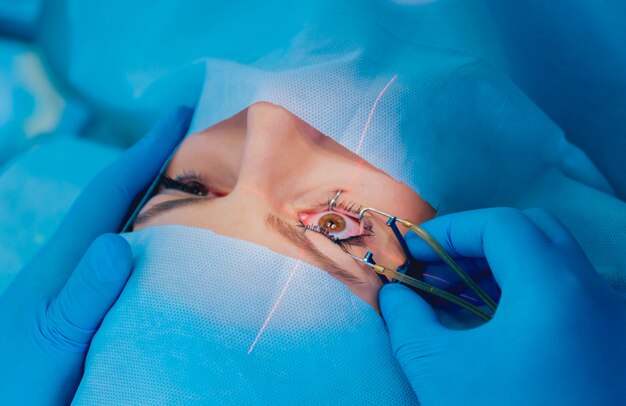 Close-up of a patient undergoing laser eye surgery, with a surgeon using instruments near the eye under sterile conditions.